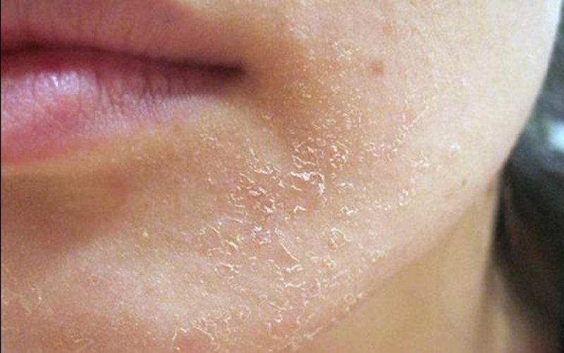 Da khô, ngứa, nứt nẻ, cách chữa